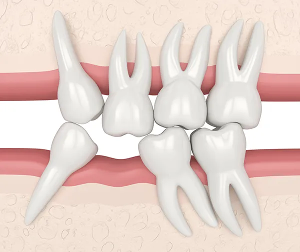 3D rendered cross-section view of seven misaligned and crooked teeth crowding the empty space where a missing tooth should be 3D rendered cross-section view of seven misaligned and crooked teeth crowding the empty space where a missing tooth should be